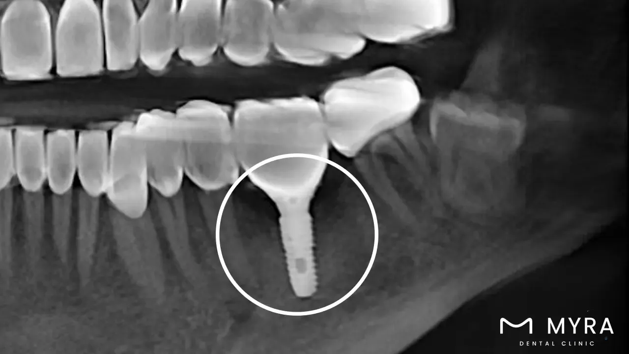 1 Single Tooth İmplnat.webp